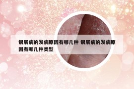 銀屑病的發(fā)病原因有哪幾種 銀屑病的發(fā)病原因有哪幾種類型