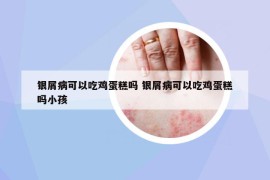 銀屑病可以吃雞蛋糕嗎 銀屑病可以吃雞蛋糕嗎小孩