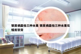 銀屑病最怕三種水果 銀屑病最怕三種水果石榴皮軟膏