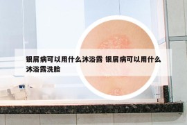 銀屑病可以用什么沐浴露 銀屑病可以用什么沐浴露洗臉