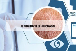 牛皮癬用水沖洗 牛皮癬遇水