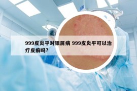 999皮炎平對銀屑病 999皮炎平可以治療皮癬嗎?