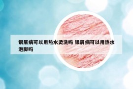 銀屑病可以用熱水燙洗嗎 銀屑病可以用熱水泡腳嗎