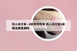 抗人白介素—8鼠單抗乳膏 抗人白介素8鼠根治銀屑病嗎