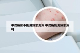 牛皮癬熊不能用熱水洗澡 牛皮癬能洗熱水澡嗎