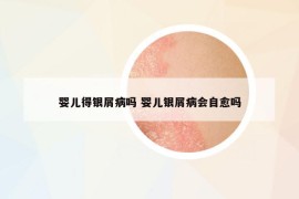 嬰兒得銀屑病嗎 嬰兒銀屑病會(huì)自愈嗎