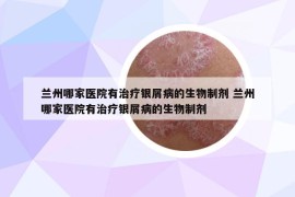 蘭州哪家醫(yī)院有治療銀屑病的生物制劑 蘭州哪家醫(yī)院有治療銀屑病的生物制劑