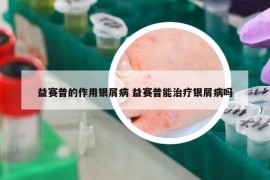 益賽普的作用銀屑病 益賽普能治療銀屑病嗎