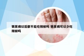銀屑病以后都不能吃辣椒嗎 銀屑病可以少吃辣椒嗎