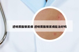 透明質酸銀屑病 透明質酸銀屑病能治好嗎