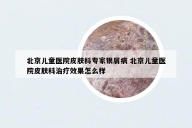 北京兒童醫(yī)院皮膚科專家銀屑病 北京兒童醫(yī)院皮膚科治療效果怎么樣