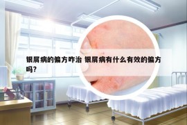 銀屑病的偏方咋治 銀屑病有什么有效的偏方嗎?