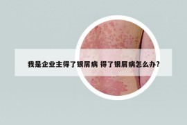 我是企業(yè)主得了銀屑病 得了銀屑病怎么辦?