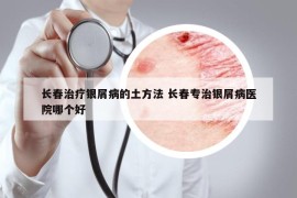 長春治療銀屑病的土方法 長春專治銀屑病醫(yī)院哪個好