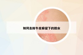 如何去除牛皮癬留下的膠水