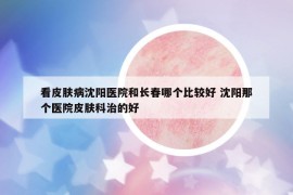 看皮膚病沈陽(yáng)醫(yī)院和長(zhǎng)春哪個(gè)比較好 沈陽(yáng)那個(gè)醫(yī)院皮膚科治的好