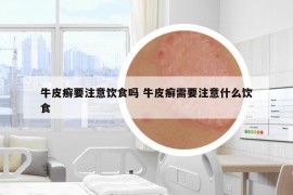 牛皮癬要注意飲食嗎 牛皮癬需要注意什么飲食