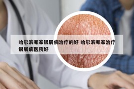 哈爾濱哪家銀屑病治療的好 哈爾濱哪家治療銀屑病醫(yī)院好