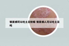 銀屑病可以吃土豆粉嘛 銀屑病人可以吃土豆嗎