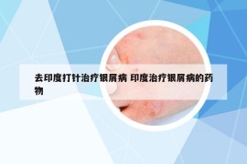 去印度打針治療銀屑病 印度治療銀屑病的藥物