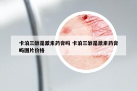 卡泊三醇是激素藥膏嗎 卡泊三醇是激素藥膏嗎圖片價(jià)格