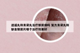 逍遙丸和青黛丸治療銀屑病嗎 復(fù)方青黛丸和郁金銀屑片哪個治療效果好