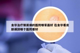 金華治療銀屑病的醫(yī)院哪家最好 在金華看皮膚病到哪個(gè)醫(yī)院看好