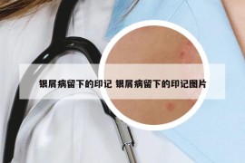 銀屑病留下的印記 銀屑病留下的印記圖片