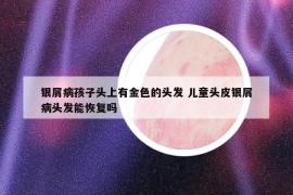 銀屑病孩子頭上有金色的頭發(fā) 兒童頭皮銀屑病頭發(fā)能恢復(fù)嗎