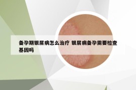 備孕期銀屑病怎么治療 銀屑病備孕需要檢查基因嗎