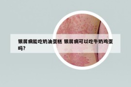 銀屑病能吃奶油蛋糕 銀屑病可以吃牛奶雞蛋嗎?