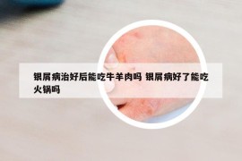 銀屑病治好后能吃牛羊肉嗎 銀屑病好了能吃火鍋嗎