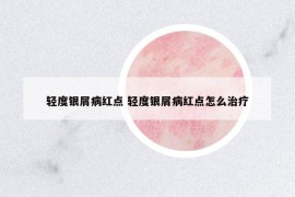 輕度銀屑病紅點(diǎn) 輕度銀屑病紅點(diǎn)怎么治療