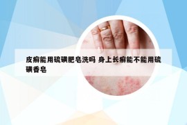 皮癬能用硫磺肥皂洗嗎 身上長(zhǎng)癬能不能用硫磺香皂