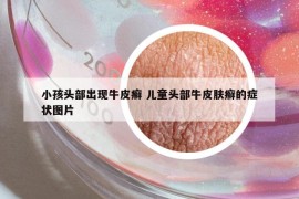 小孩頭部出現(xiàn)牛皮癬 兒童頭部牛皮膚癬的癥狀圖片