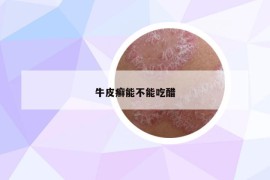 牛皮癬能不能吃醋
