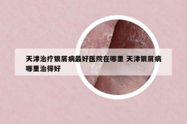 天津治療銀屑病最好醫(yī)院在哪里 天津銀屑病哪里治得好