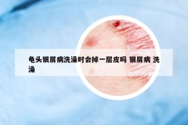 龜頭銀屑病洗澡時會掉一層皮嗎 銀屑病 洗澡