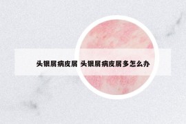頭銀屑病皮屑 頭銀屑病皮屑多怎么辦