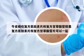 牛皮癬吃復方氨肽素片和復方甘草酸苷膠囊 復方氨肽素片和復方甘草酸苷片可以一起