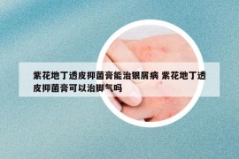 紫花地丁透皮抑菌膏能治銀屑病 紫花地丁透皮抑菌膏可以治腳氣嗎