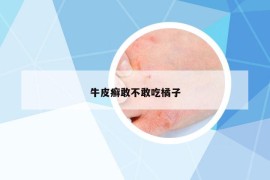牛皮癬敢不敢吃橘子