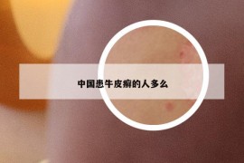 中國患牛皮癬的人多么
