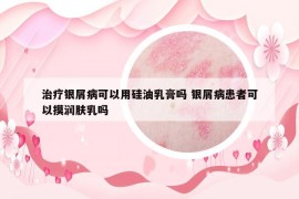 治療銀屑病可以用硅油乳膏嗎 銀屑病患者可以摸潤(rùn)膚乳嗎