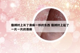 胳膊肘上長(zhǎng)了像癬一樣的東西 胳膊肘上起了一片一片的像癬