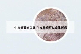 牛皮癬要吃生蠔 牛皮膚癬可以吃生蠔嗎