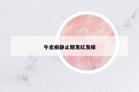 牛皮癬靜止期發(fā)紅發(fā)癢