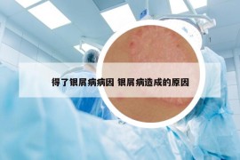 得了銀屑病病因 銀屑病造成的原因