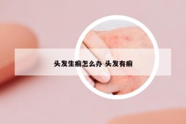 頭發(fā)生癬怎么辦 頭發(fā)有癬