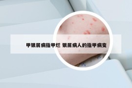 甲銀屑病指甲爛 銀屑病人的指甲病變